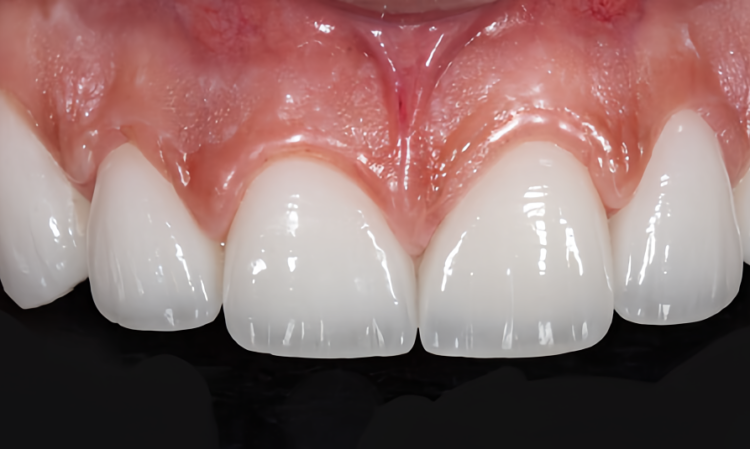 Xu hướng răng sứ, công nghệ tại Nha khoa Hoa Hồng Phương Đông